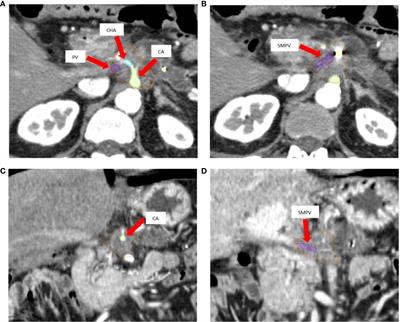 Dosimetric Feasibility Study of Dose Escalated Stereotactic Body Radiation Therapy (SBRT) in Locally Advanced Pancreatic Cancer (LAPC) Patients: It Is Time to Raise the Bar